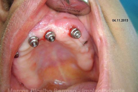 Fase Protética da Reabilitação em Maxila Atrófica