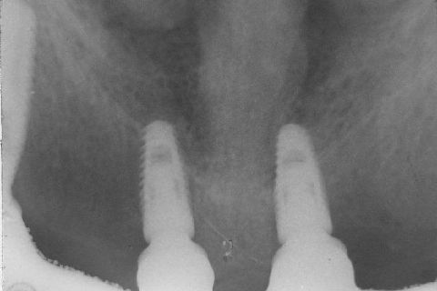 Fase Protética da Reabilitação em Maxila Atrófica