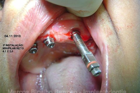 Fase Protética da Reabilitação em Maxila Atrófica