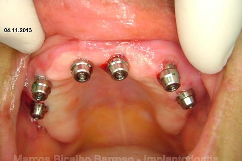 Fase Protética da Reabilitação em Maxila Atrófica