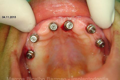 Fase Protética da Reabilitação em Maxila Atrófica