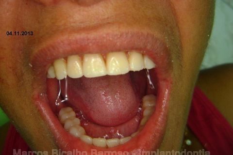 Fase Protética da Reabilitação em Maxila Atrófica