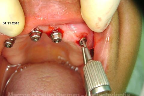 Fase Protética da Reabilitação em Maxila Atrófica