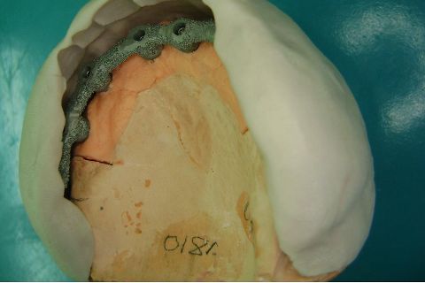 Fase Protética da Reabilitação em Maxila Atrófica