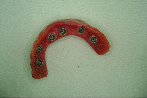 Fase Protética da Reabilitação em Maxila Atrófica