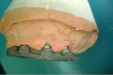 Fase Protética da Reabilitação em Maxila Atrófica