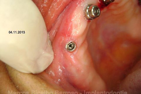 Fase Protética da Reabilitação em Maxila Atrófica