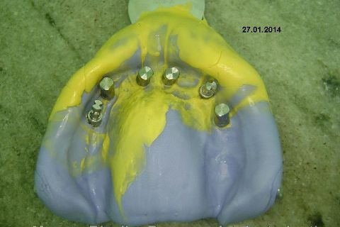 Fase Protética da Reabilitação em Maxila Atrófica