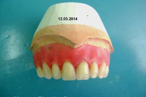 Fase Protética da Reabilitação em Maxila Atrófica