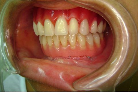 Fase Protética da Reabilitação em Maxila Atrófica