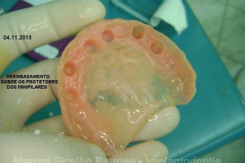Fase Protética da Reabilitação em Maxila Atrófica