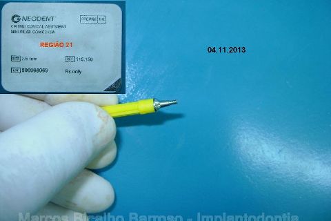 Fase Protética da Reabilitação em Maxila Atrófica