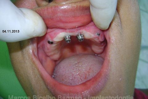 Fase Protética da Reabilitação em Maxila Atrófica