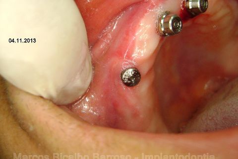 Fase Protética da Reabilitação em Maxila Atrófica