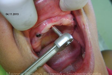 Fase Protética da Reabilitação em Maxila Atrófica