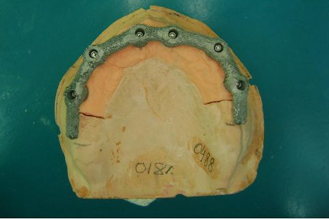 Fase Protética da Reabilitação em Maxila Atrófica