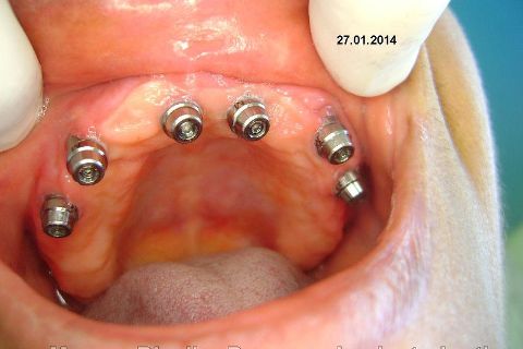 Fase Protética da Reabilitação em Maxila Atrófica