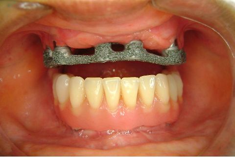 Fase Protética da Reabilitação em Maxila Atrófica