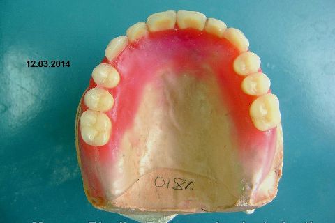 Fase Protética da Reabilitação em Maxila Atrófica