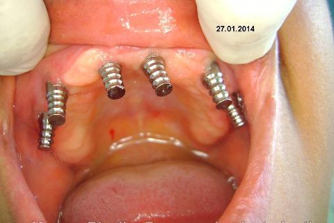Fase Protética da Reabilitação em Maxila Atrófica