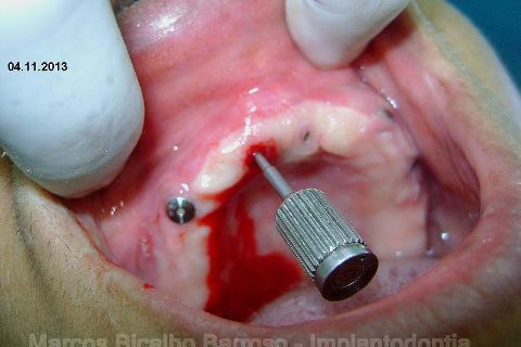 Fase Protética da Reabilitação em Maxila Atrófica