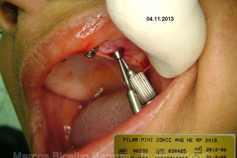 Fase Protética da Reabilitação em Maxila Atrófica