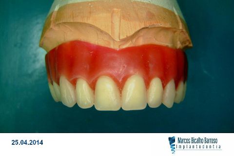 Fase Protética da Reabilitação em Maxila Atrófica