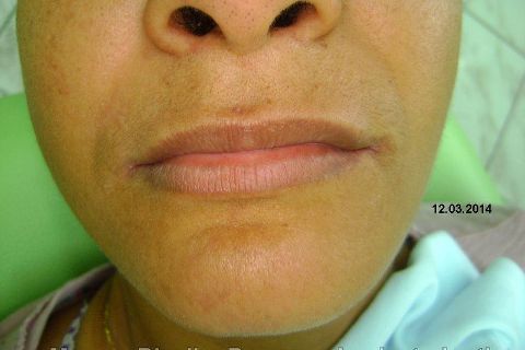 Fase Protética da Reabilitação em Maxila Atrófica