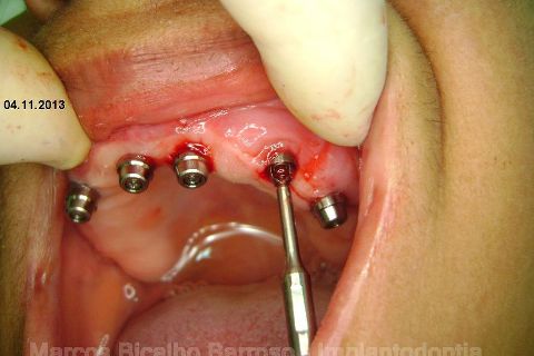 Fase Protética da Reabilitação em Maxila Atrófica