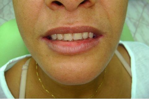 Fase Protética da Reabilitação em Maxila Atrófica