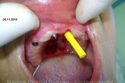 Fase Protética da Reabilitação em Maxila Atrófica