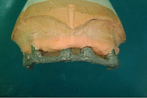 Fase Protética da Reabilitação em Maxila Atrófica