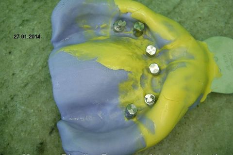 Fase Protética da Reabilitação em Maxila Atrófica