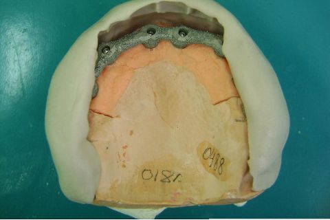 Fase Protética da Reabilitação em Maxila Atrófica