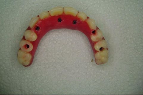 Fase Protética da Reabilitação em Maxila Atrófica