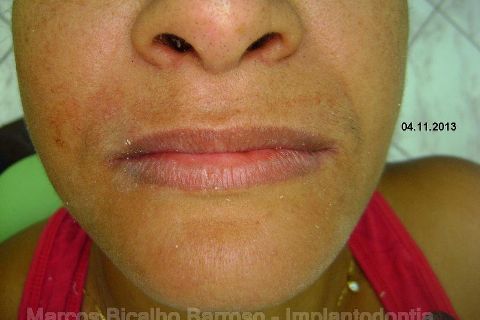 Fase Protética da Reabilitação em Maxila Atrófica