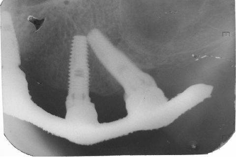 Fase Protética da Reabilitação em Maxila Atrófica