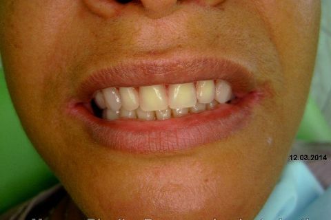 Fase Protética da Reabilitação em Maxila Atrófica