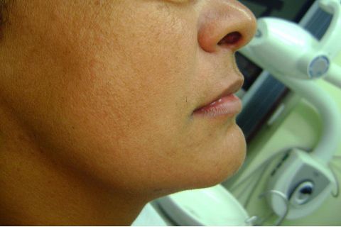 Fase Protética da Reabilitação em Maxila Atrófica