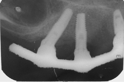 Fase Protética da Reabilitação em Maxila Atrófica