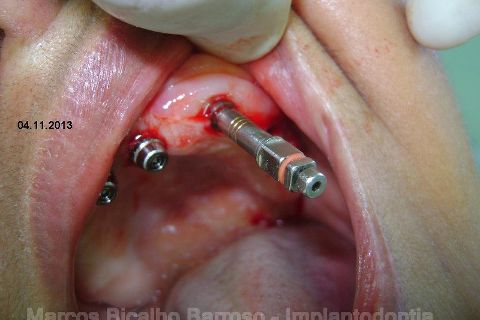 Fase Protética da Reabilitação em Maxila Atrófica