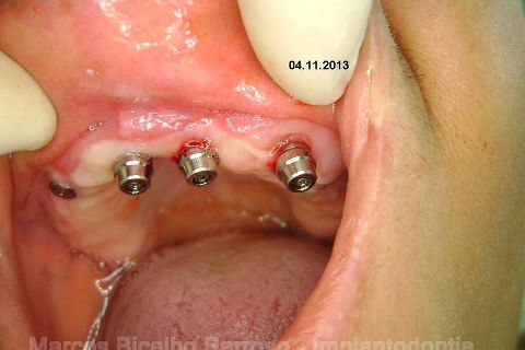 Fase Protética da Reabilitação em Maxila Atrófica