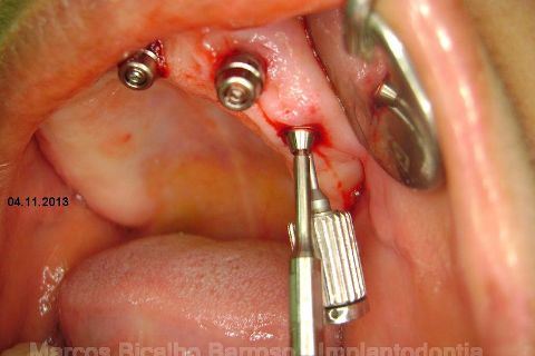 Fase Protética da Reabilitação em Maxila Atrófica