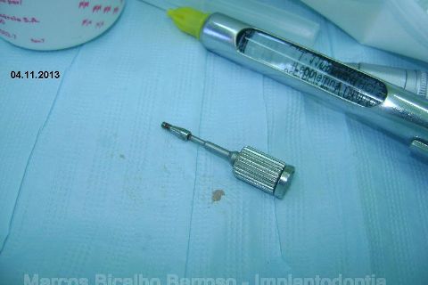 Fase Protética da Reabilitação em Maxila Atrófica