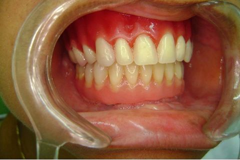 Fase Protética da Reabilitação em Maxila Atrófica