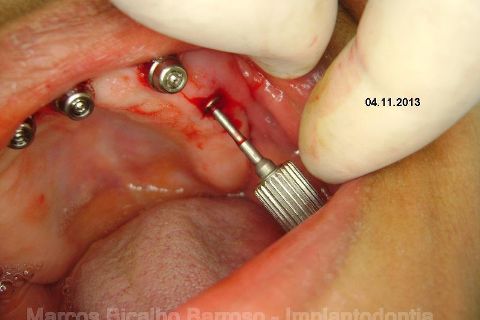 Fase Protética da Reabilitação em Maxila Atrófica