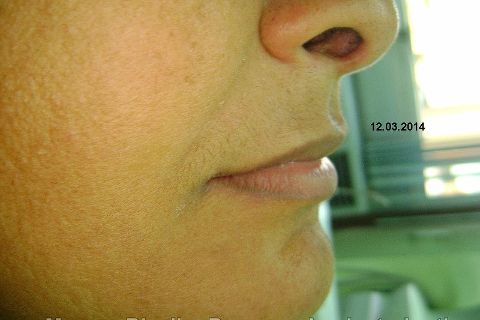 Fase Protética da Reabilitação em Maxila Atrófica