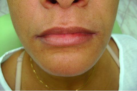 Fase Protética da Reabilitação em Maxila Atrófica