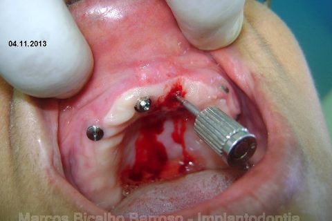 Fase Protética da Reabilitação em Maxila Atrófica