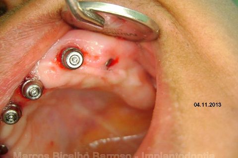 Fase Protética da Reabilitação em Maxila Atrófica